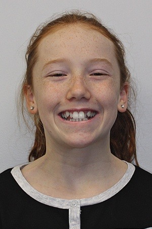Teen girl with crooked unevenly spaced teeth before orthodontic treatment