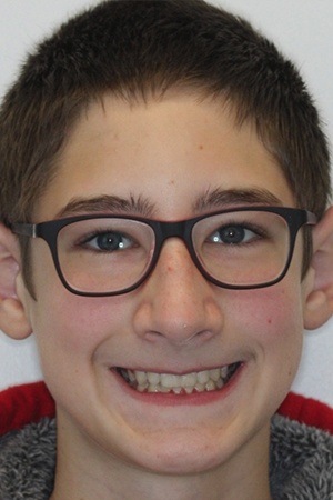 Boy with healthy aligned smile after orthodontic treatment