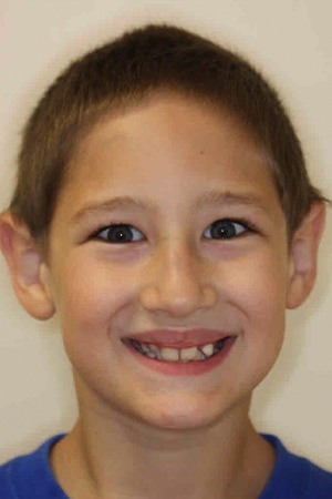 Boy with crooked teeth before orthodontic treatment