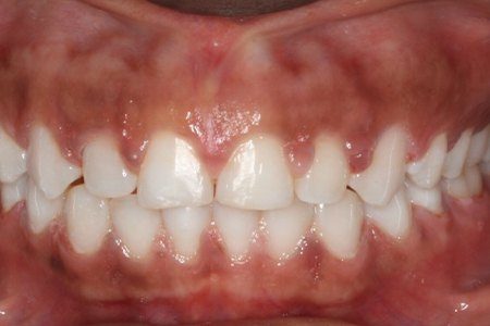 Closeup of smile with even tooth spacing after orthodontic treatment