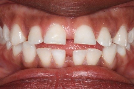 Closeup of smile with large spaces between teeth