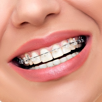 Closeup of smile with adult orthodontics