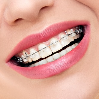Closeup of smile with clear and ceramic braces