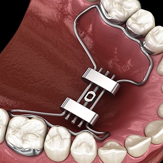 Animated smile with dentofacial orthopedics