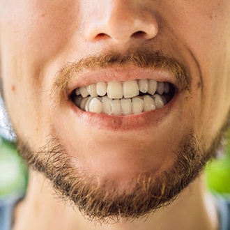 Closeup of smile with bite plate