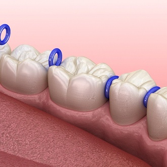 Animated smile with spacers