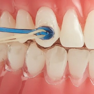 Carriere appliance on teeth