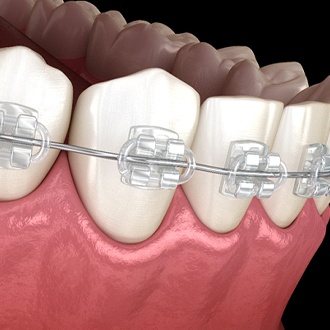 An up-close digital view of metal brackets and an archwire on the lower arch of teeth