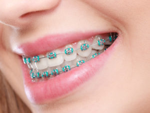 Closeup of braces in New Hampshire