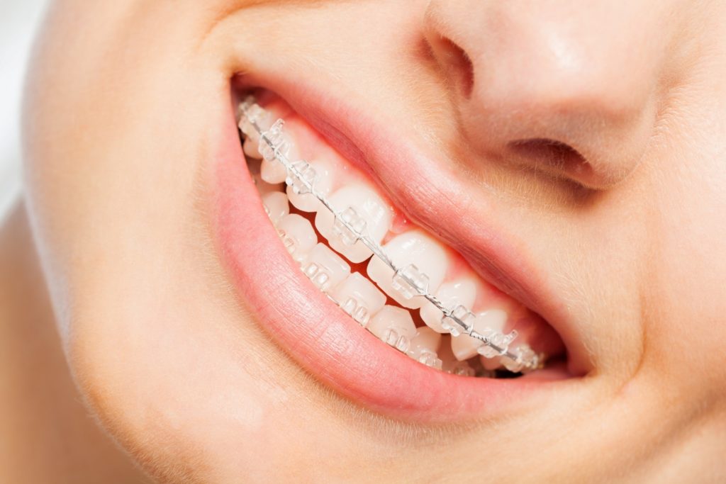 Closeup of patient smiling with braces