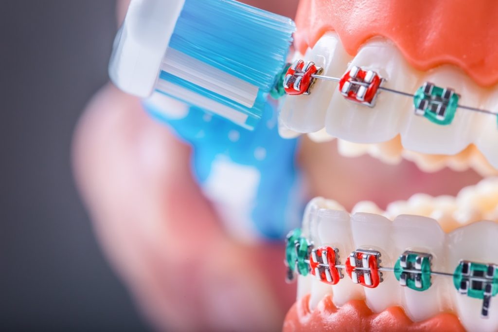 Closeup of toothbrush cleaning colored metal braces