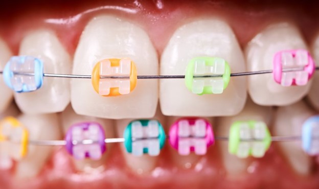 Closeup of colorful braces in shades of pastel
