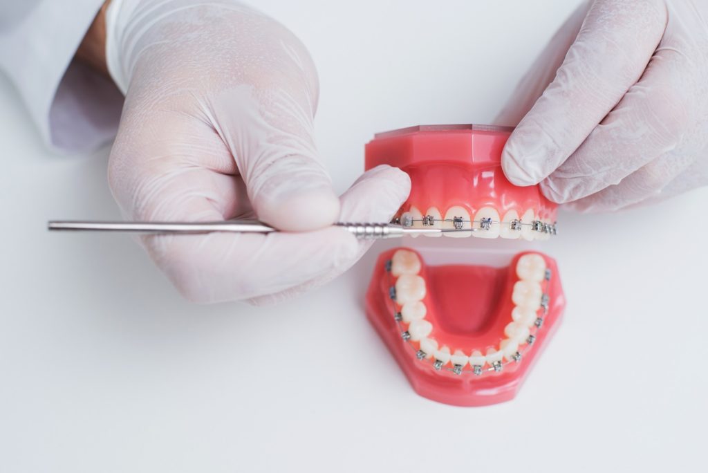 Orthodontist pointing to model of teeth