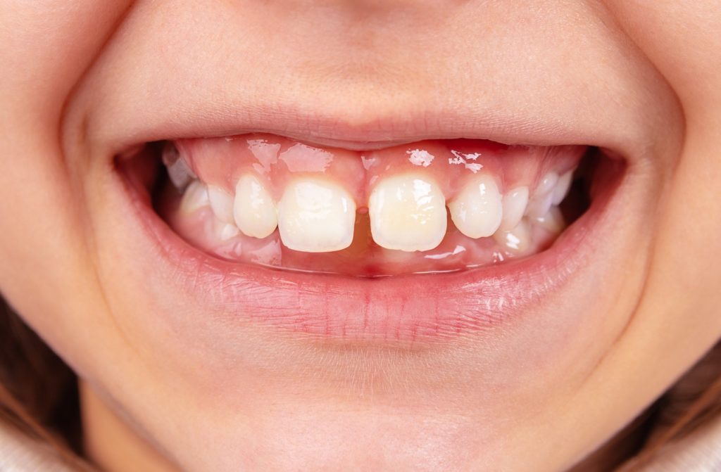 Child smiling with gapped teeth and uneven bite