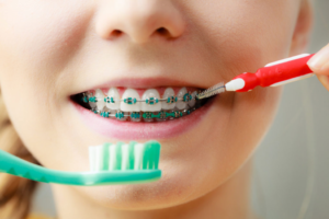 a teen with braces brushing their teeth 